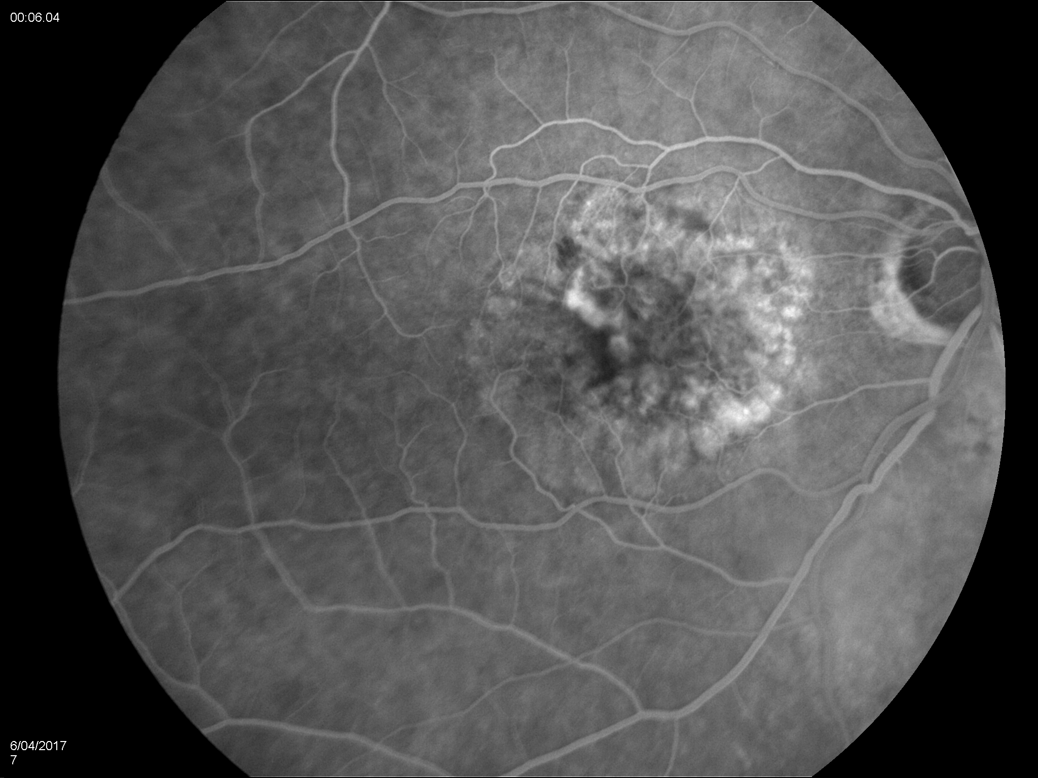 Maculadegeneratie ARMD Flue